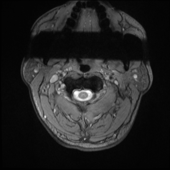 File:Cervical disc extrusion (Radiopaedia 53950-60077 Axial T2 1).jpg