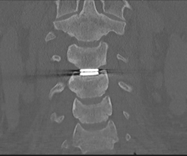 File:Cervical disc replacement (Radiopaedia 44025-47541 Coronal bone window 18).png
