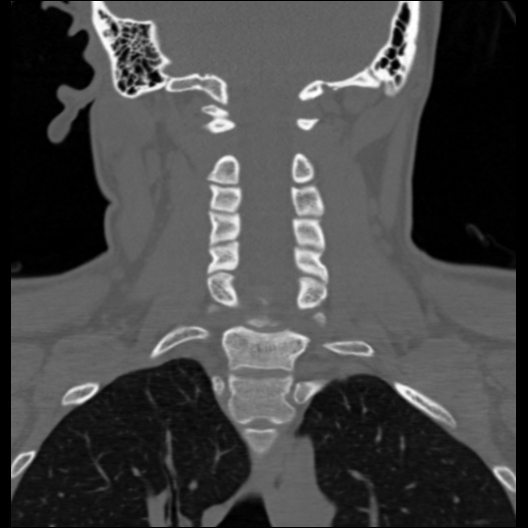 File:Cervical rib (Radiopaedia 71110-81363 Coronal non-contrast 23).jpg
