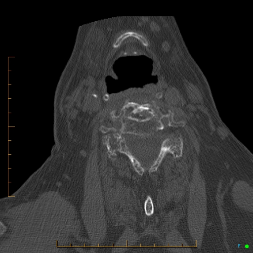 File:Cervical spine fracture - ankylosing spondylitis (Radiopaedia 76835-88706 Axial bone window 132).jpg