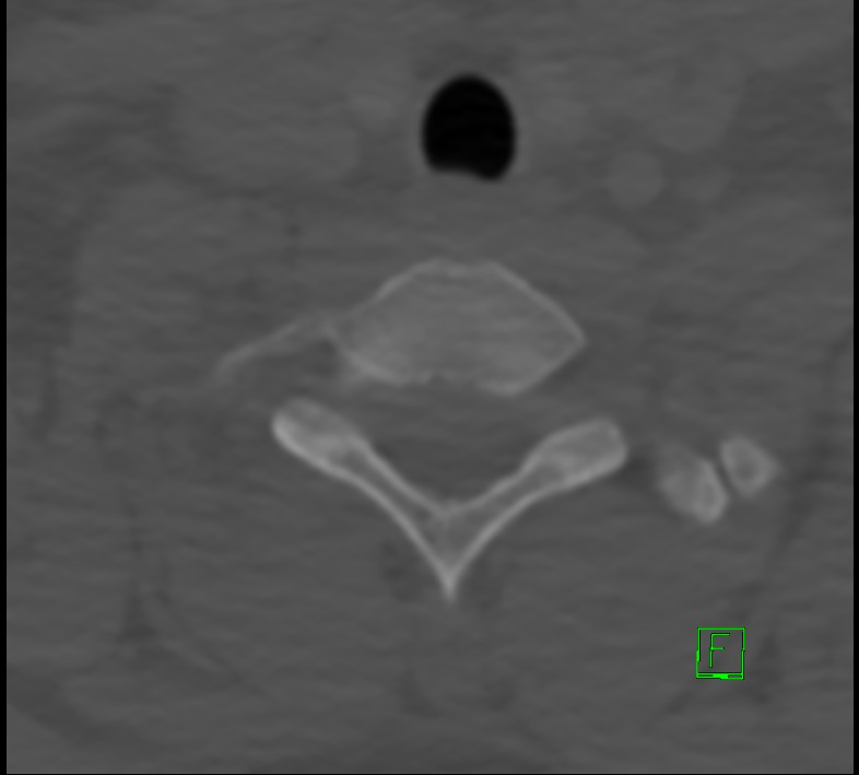 Cervical spine fracture - hyperflexion injury (Radiopaedia 66184-75364 Axial bone window 48).jpg