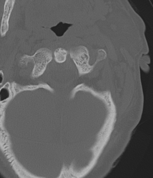 Cervical spine fracture in the setting of ankylosis (Radiopaedia 37038-38715 Axial bone window 14).png