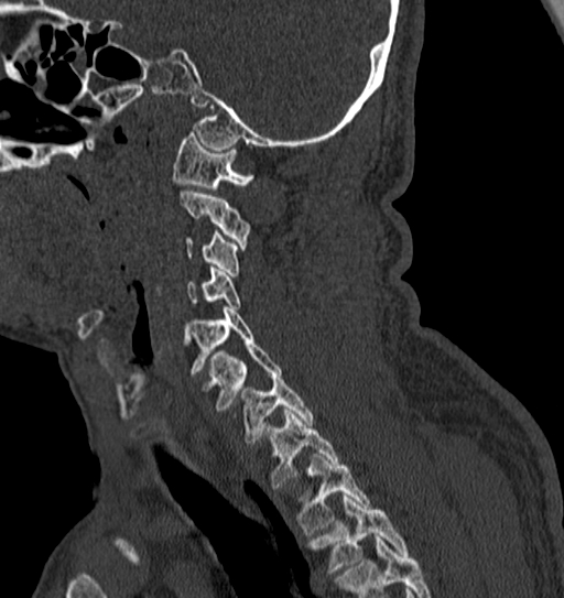 Cervical spine trauma with tear drop fracture and perched facet joint (Radiopaedia 53989-60127 Sagittal bone window 45).jpg