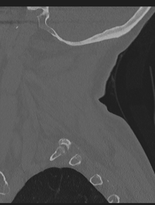 Cervical spondylolysis (Radiopaedia 49616-54811 Sagittal bone window 14).png