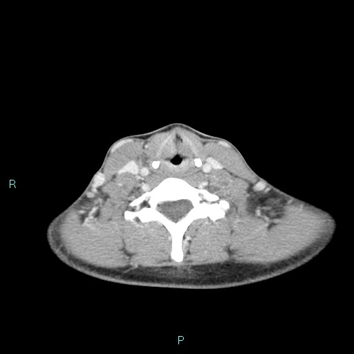 File:Cervical thymic cyst (Radiopaedia 88632-105335 C 47).jpg