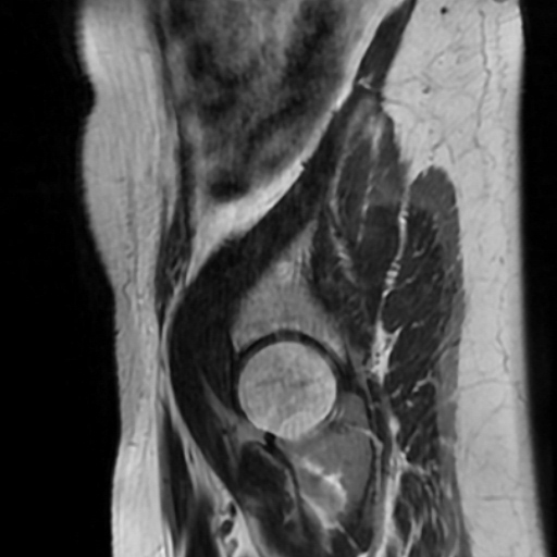 File:Cesarian section scar endometriosis (Radiopaedia 66520-75799 Sagittal T2 19).jpg