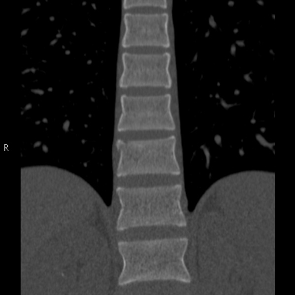 Chance fracture (Radiopaedia 36521-38081 Coronal bone window 22).jpg