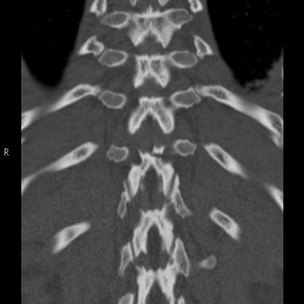 File:Chance fracture (Radiopaedia 36521-38081 Coronal bone window 49).jpg