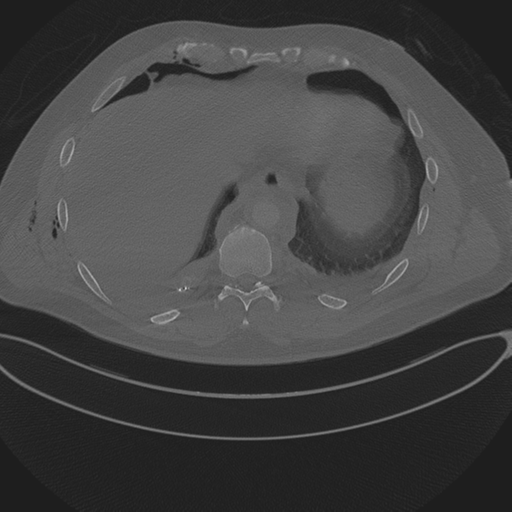 File:Chest multitrauma - aortic injury (Radiopaedia 34708-36147 Axial bone window 235).png
