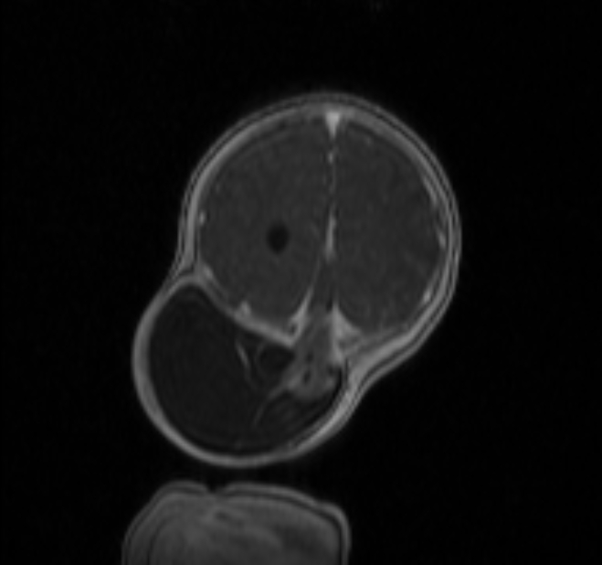 Chiari III malformation with occipital encephalocele (Radiopaedia 79446-92559 Coronal T1 C+ mpr 44).jpg