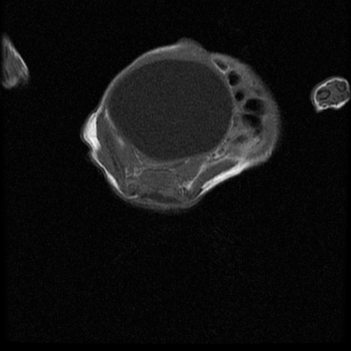 File:Chiari II malformation with spinal meningomyelocele (Radiopaedia 23550-23652 Axial T1 15).jpg