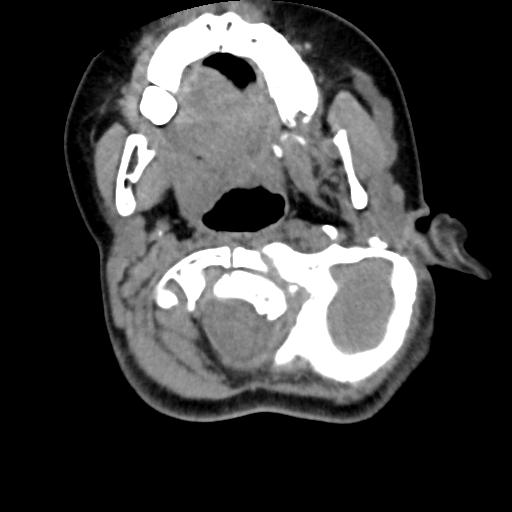 Chiari I with syrinx and skull base anomalies (Radiopaedia 89444-106412 Axial non-contrast 48).jpg