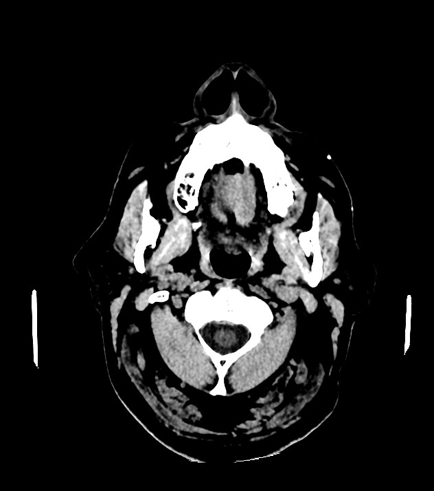 Cholangiocarcinoma with cerebral metastases (Radiopaedia 83519-98628 Axial non-contrast 2).jpg
