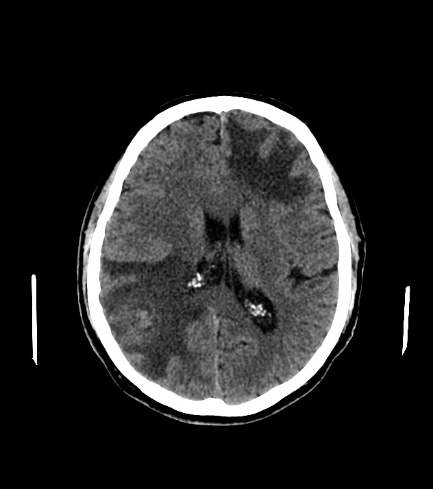 Cholangiocarcinoma with cerebral metastases (Radiopaedia 83519-98628 Axial non-contrast 40).jpg