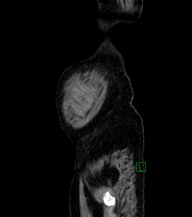 Cholangiocarcinoma with cerebral metastases (Radiopaedia 83519-98629 F 113).jpg