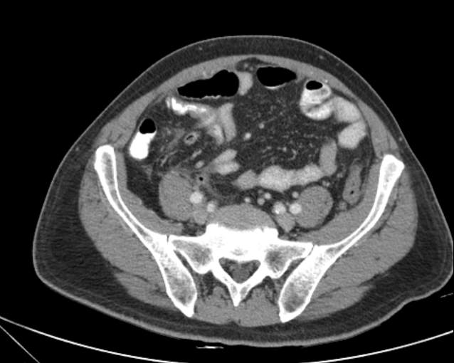 Cholecystitis - perforated gallbladder (Radiopaedia 57038-63916 A 61).jpg
