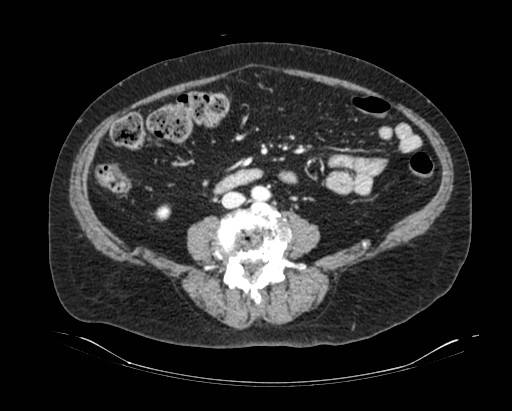 File:Cholecystoduodenal fistula (Radiopaedia 48959-54022 A 12).jpg