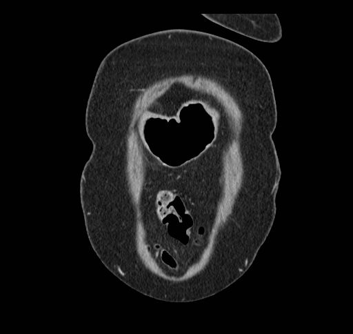 Cholecystoduodenal fistula (Radiopaedia 48959-54022 B 18).jpg