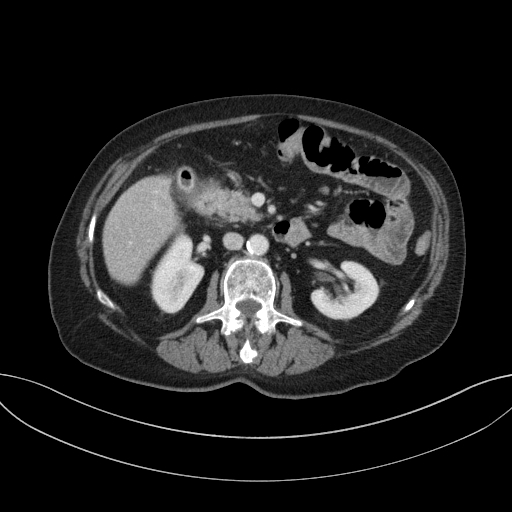 Cholecystoduodenal fistula due to calculous cholecystitis with gallstone migration (Radiopaedia 86875-103077 D 36).jpg