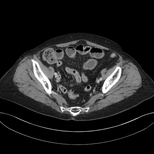 Cholecystoduodenal fistula due to calculous cholecystitis with gallstone migration (Radiopaedia 86875-103077 D 66).jpg