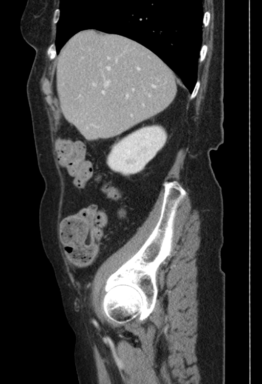 Cholecystoduodenal fistula due to calculous cholecystitis with gallstone migration (Radiopaedia 86875-103077 F 46).jpg