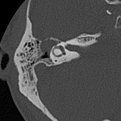 File:Cholesteatoma (Radiopaedia 15846-15494 bone window 10).jpg