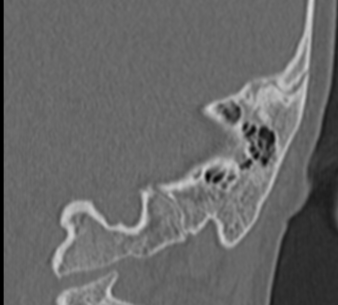 Cholesteatoma (Radiopaedia 73023-83750 Coronal Left ear 68).jpg