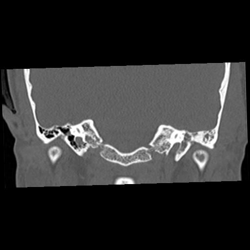 Cholesteatoma (Radiopaedia 84960-100474 Coronal bone window 28).jpg
