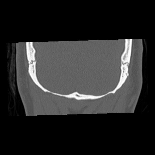 File:Cholesteatoma (Radiopaedia 84960-100474 Coronal bone window 77).jpg