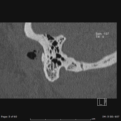 Cholesteatoma - external auditory canal (Radiopaedia 88452-105096 Sagittal bone window 5).jpg