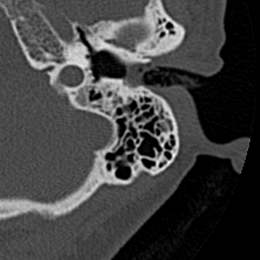 File:Cholesteatoma of the external ear (Radiopaedia 16540-16225 Axial bone window 25).jpg
