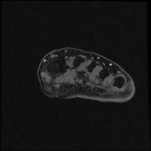 File:Chondroblastoma - midfoot (Radiopaedia 64831-73765 F 29).jpg