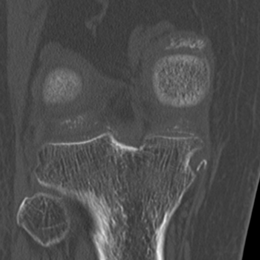 Chondrocalcinosis (Radiopaedia 16275-15955 Coronal bone window 42).jpg