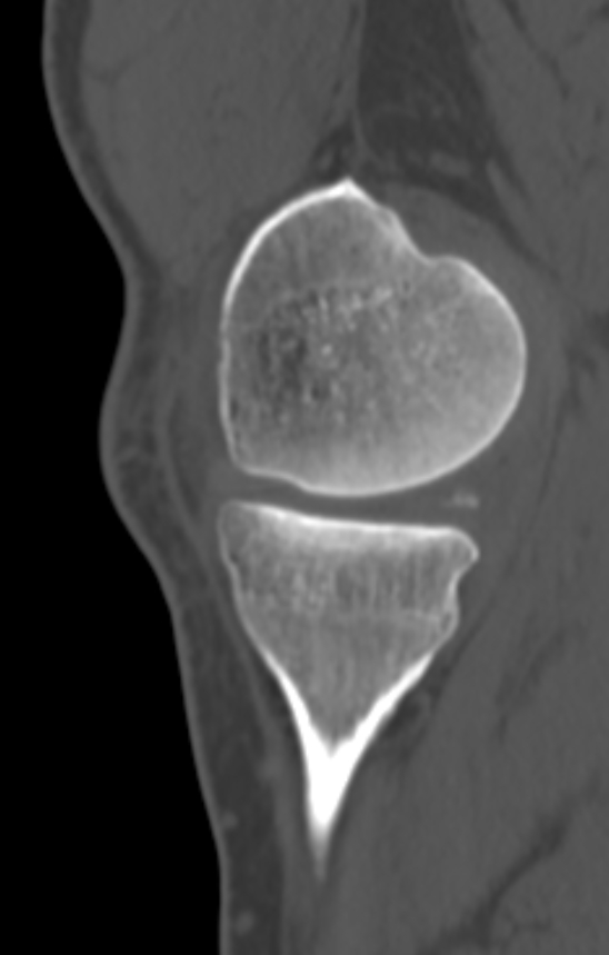 Chondrocalcinosis (Radiopaedia 82862-97173 Sagittal bone window 14).jpg
