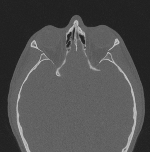 Chondrosarcoma (clivus) (Radiopaedia 46895-51425 Axial bone window 23).png