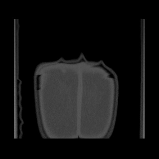 Chondrosarcoma of iliac wing (Radiopaedia 63861-72599 Coronal bone window 115).jpg