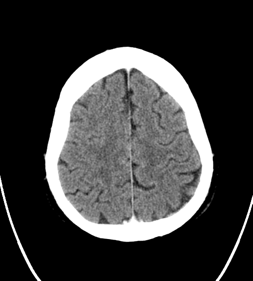 File:Chondrosarcoma of skull base- grade II (Radiopaedia 40948-43653 Axial Contrast 24).png