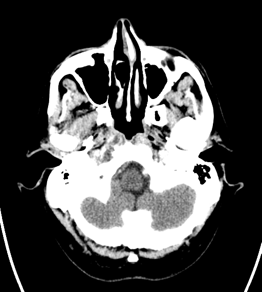 File:Chondrosarcoma of skull base- grade II (Radiopaedia 40948-43653 Axial Contrast 4).png