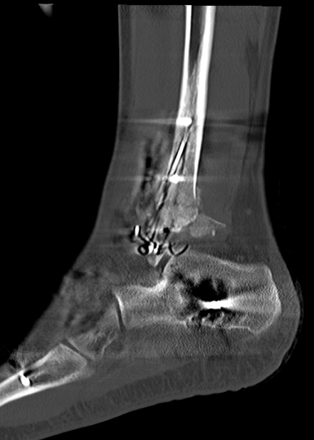 Chopart fracture (Radiopaedia 35347-36861 Sagittal bone window 54).jpg