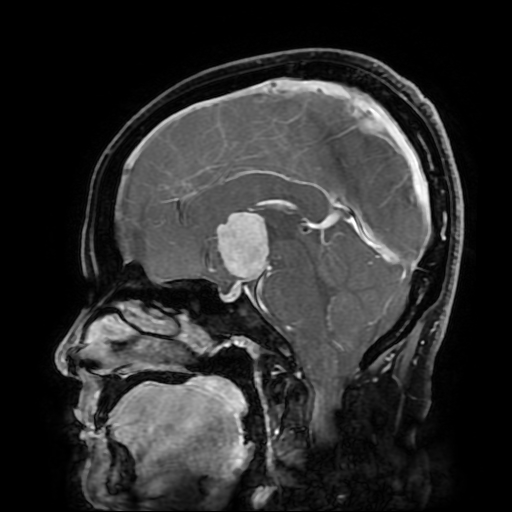 File:Chordoid glioma of third ventricle (Radiopaedia 91612-109340 F 107).jpg