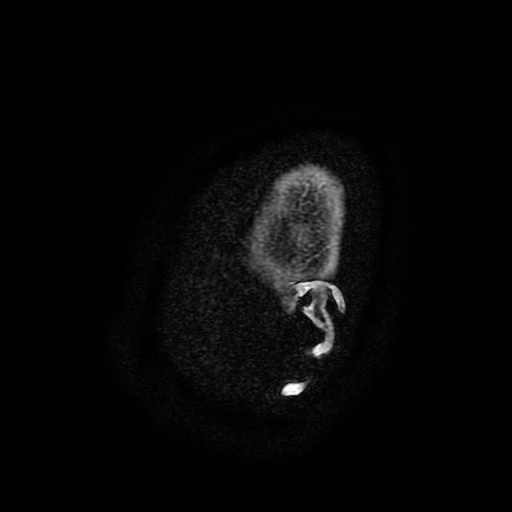 Chordoid glioma of third ventricle (Radiopaedia 91612-109340 F 206).jpg