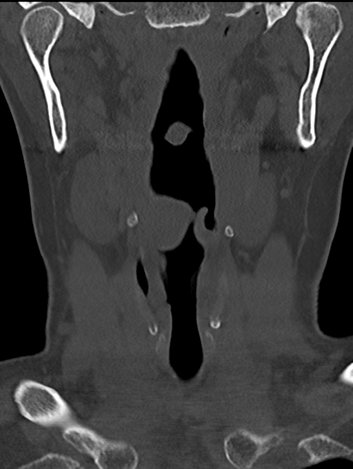 Chordoma (C4 vertebra) (Radiopaedia 47561-52188 Coronal bone window 4).png