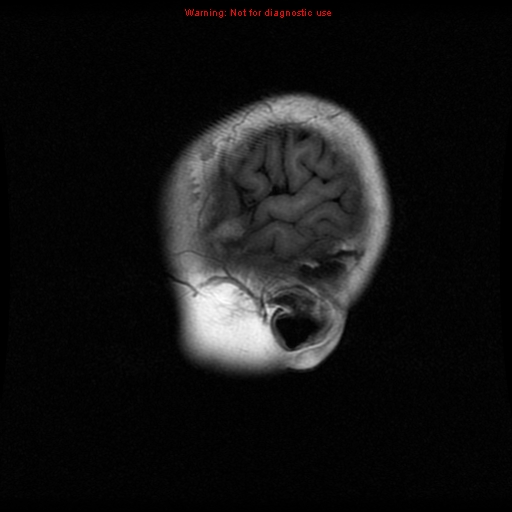 File:Choroid plexus carcinoma - recurrent (Radiopaedia 8330-9169 Sagittal T1 1).jpg
