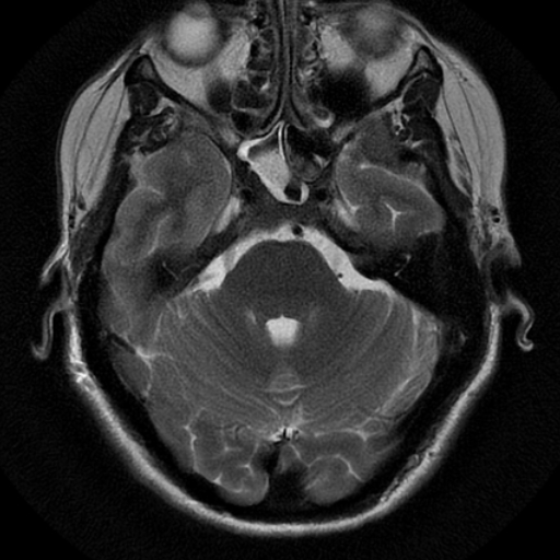 File:Choroid plexus xanthogranuloma (Radiopaedia 17650-17386 T2 18).jpg