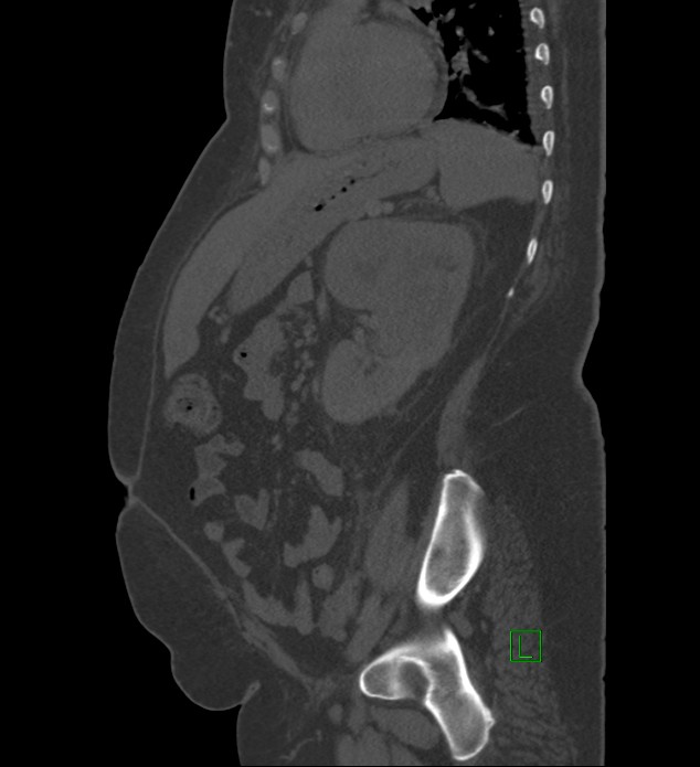 Chromophobe renal cell carcinoma (Radiopaedia 84239-99519 Sagittal bone window 35).jpg