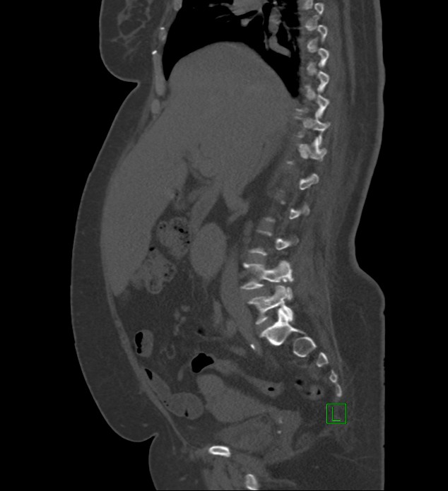 Chromophobe renal cell carcinoma (Radiopaedia 84239-99519 Sagittal bone window 65).jpg