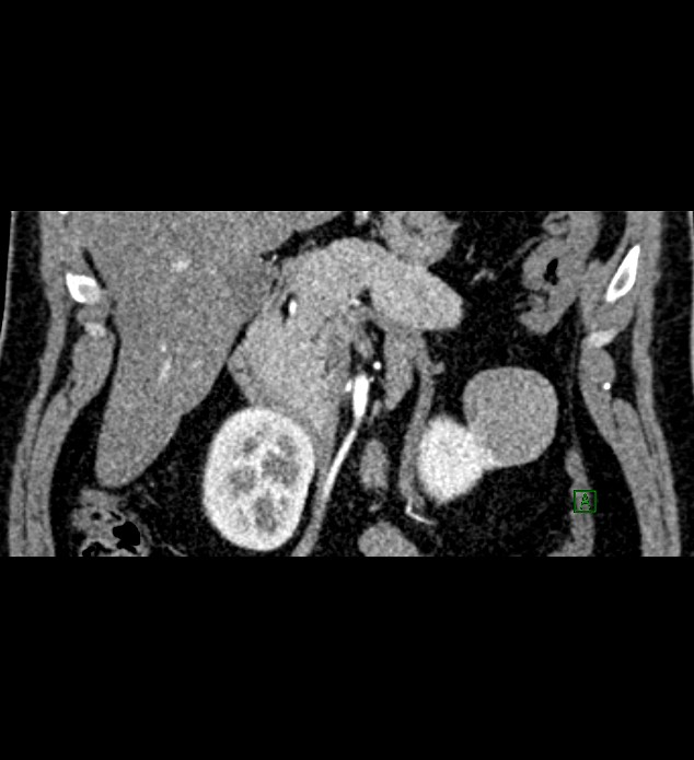 Chromophobe renal cell carcinoma (Radiopaedia 84286-99573 E 19).jpg