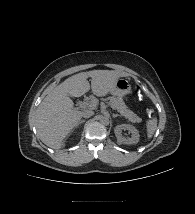 Chromophobe renal cell carcinoma (Radiopaedia 84337-99644 Axial non-contrast 28).jpg