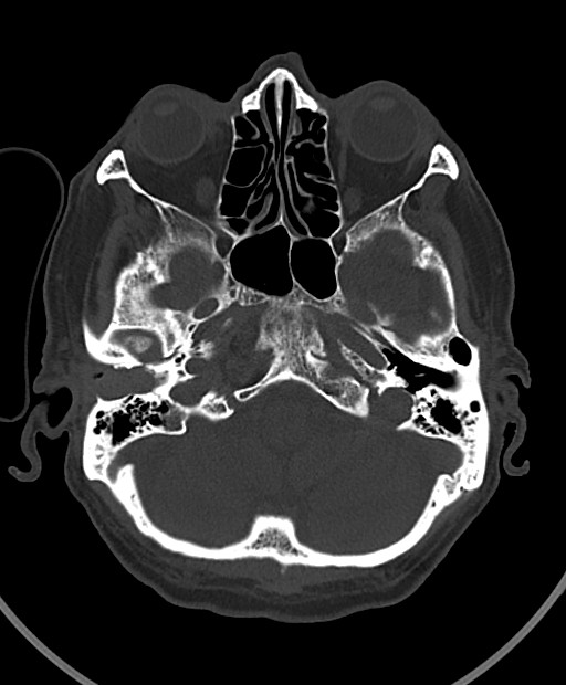 Chronic bilateral subdural hygroma (Radiopaedia 85801-101623 Axial bone window 97).jpg