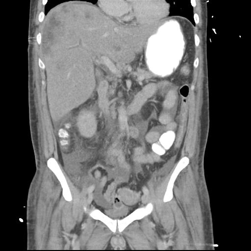 Chronic diverticulitis complicated by hepatic abscess and portal vein thrombosis (Radiopaedia 30301-30938 B 28).jpg